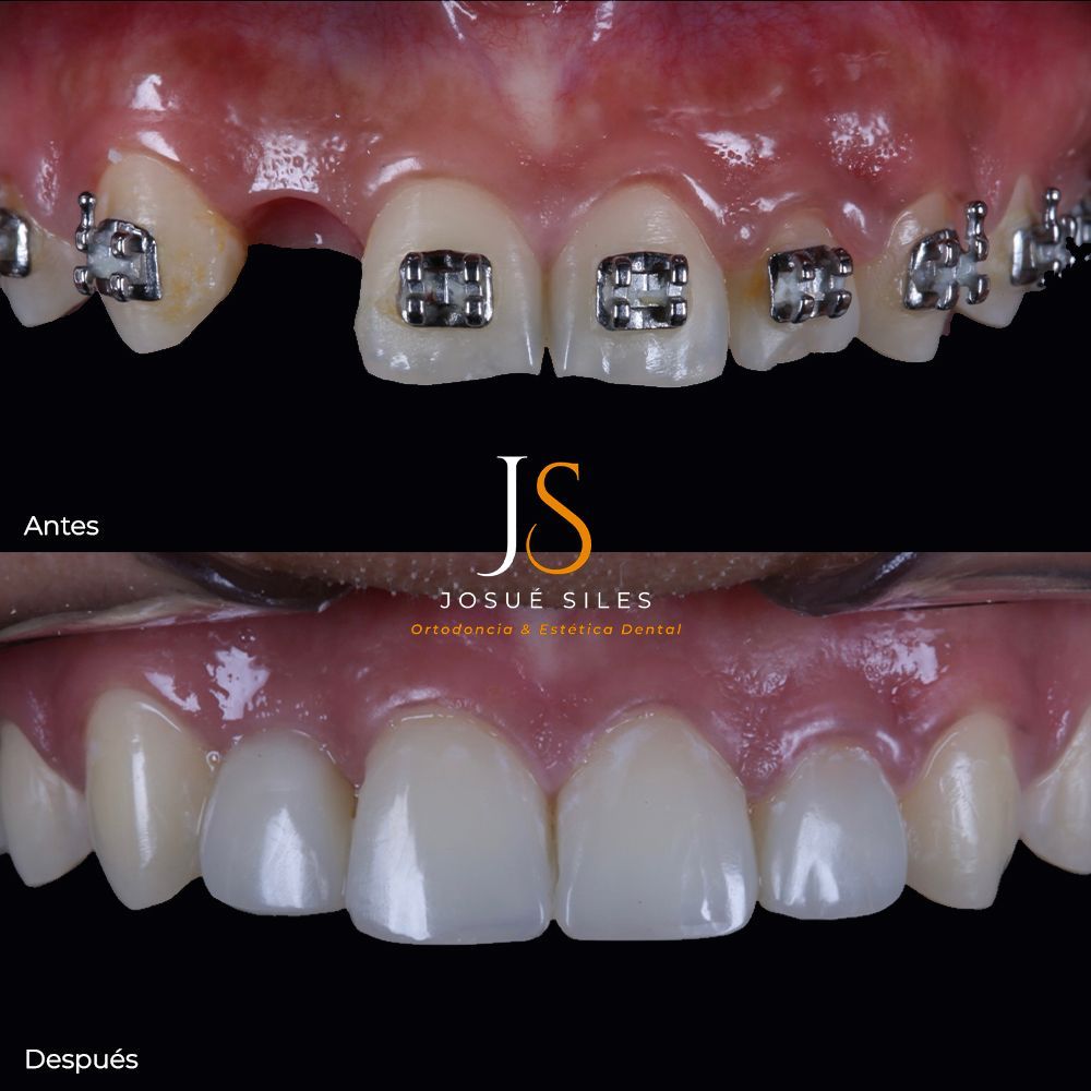 Antes---Despues-2