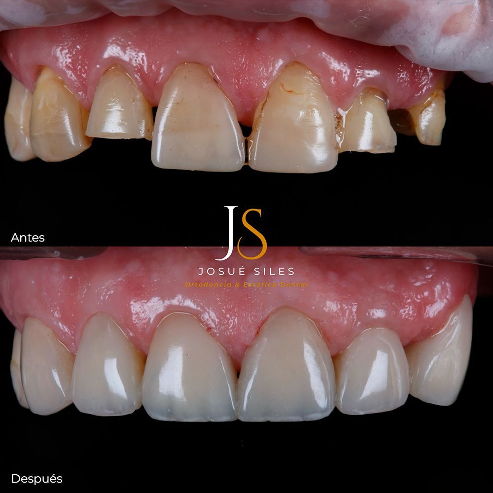 Antes---Despues